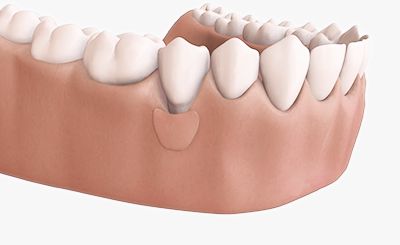 Greffe osseuse et gingivale